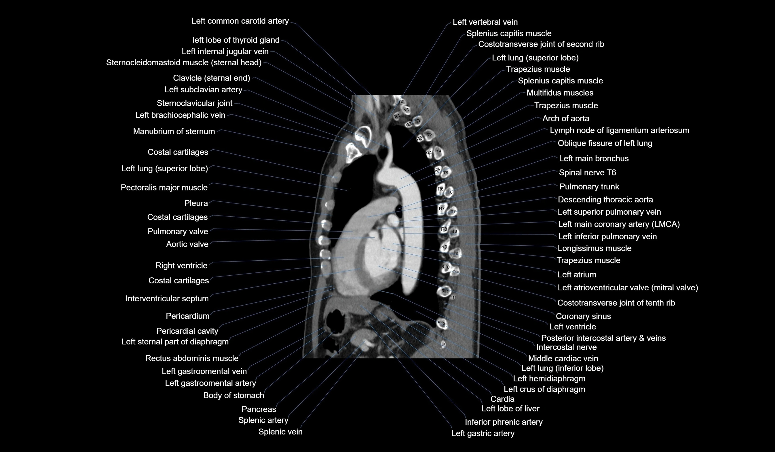 CT chest (thorax) soft tissue window labelled sagittal cross sectional anatomy radiology image-00083.webp